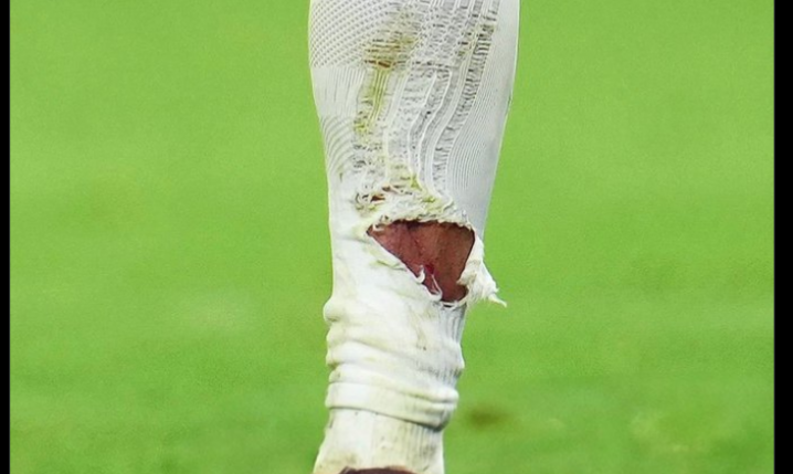 Tak wyglądała NOGA Kyliana Mbappe po wejściu Taha.. O.o