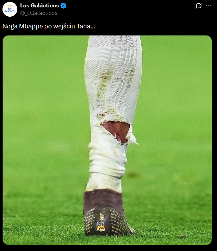 Tak wyglądała NOGA Kyliana Mbappe po wejściu Taha.. O.o