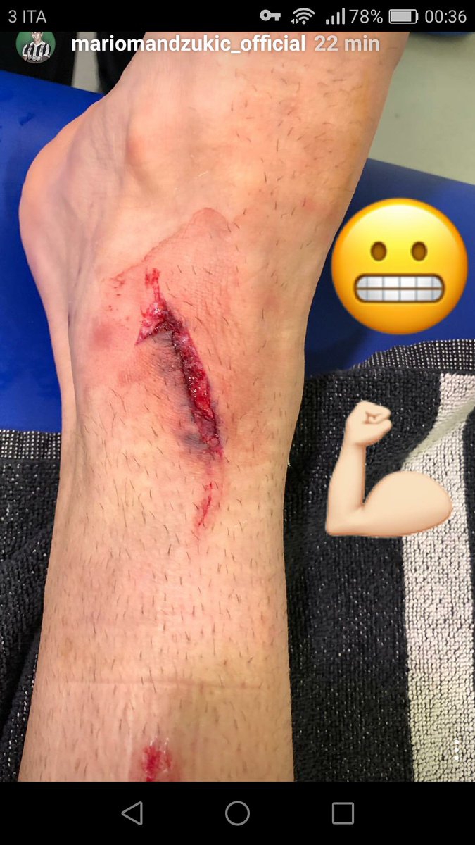 Dziura w nodze Mandżukicia po wczorajszym meczu z Interem